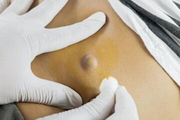 Can a lipoma turn into cancer?