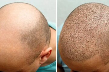 Common Concerns While Considering Hair Transplant Treatment