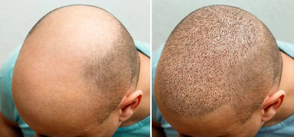 Common Concerns While Considering Hair Transplant Treatment